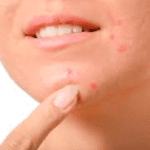 Acne - Che Cosa è Esattamente?