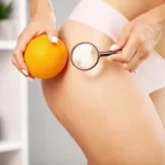 la cellulite è un malattia